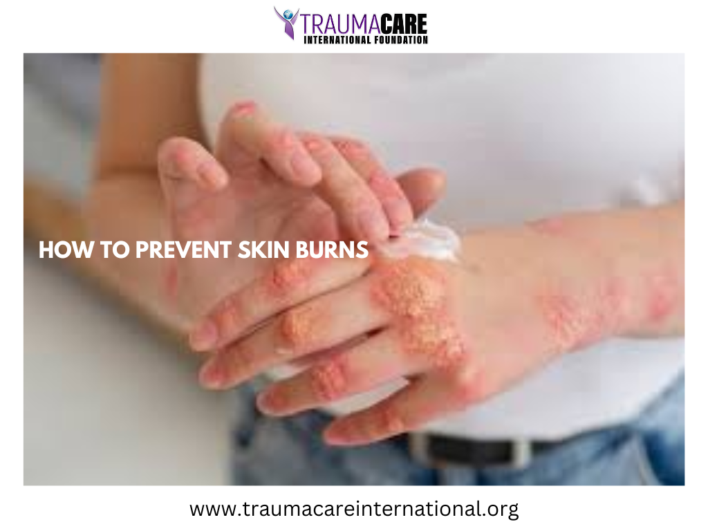 HOW TO PREVENT SKIN BURNS
